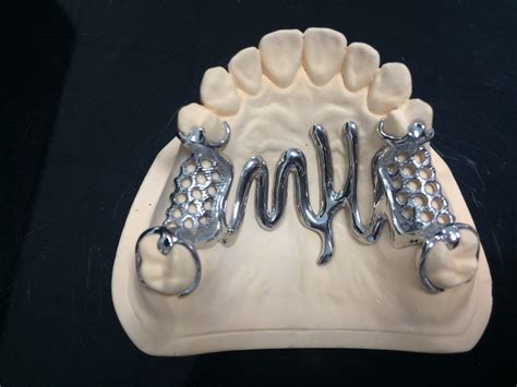 metals used to fabricate removable partial denture frameworks|mandibular partial denture cast metal.